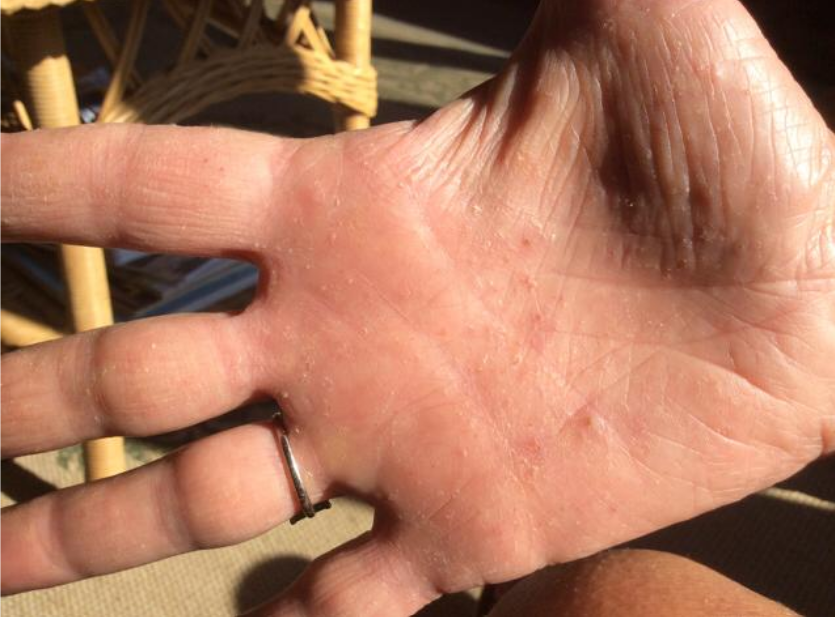 التهاب الجلد التماسي